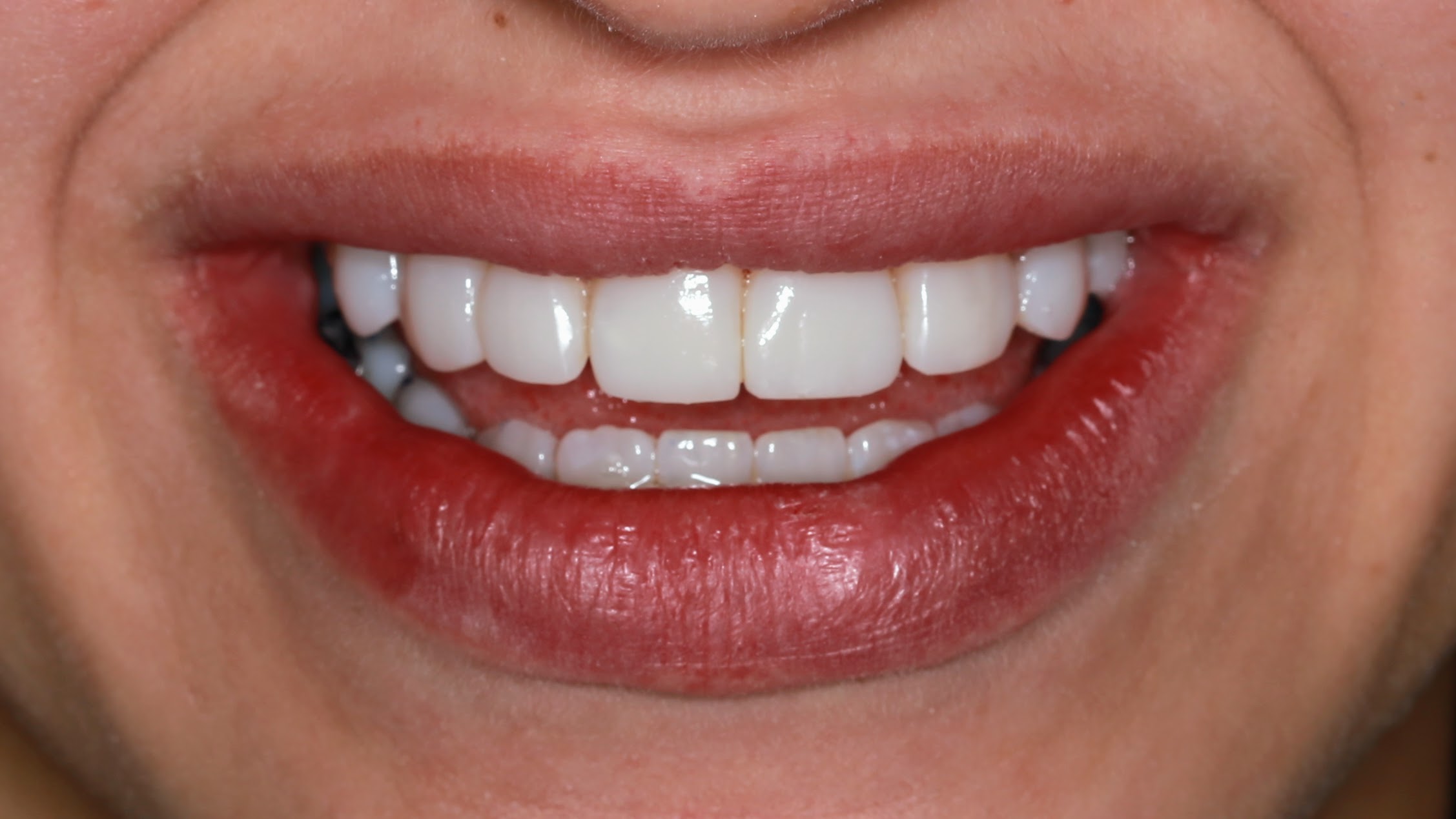 Efekty zabiegu Flow Injection bonding w gabinecie Elite Smile [Wstaw Tutaj Swoje Miasto] - metamorfoza uśmiechu przed i po