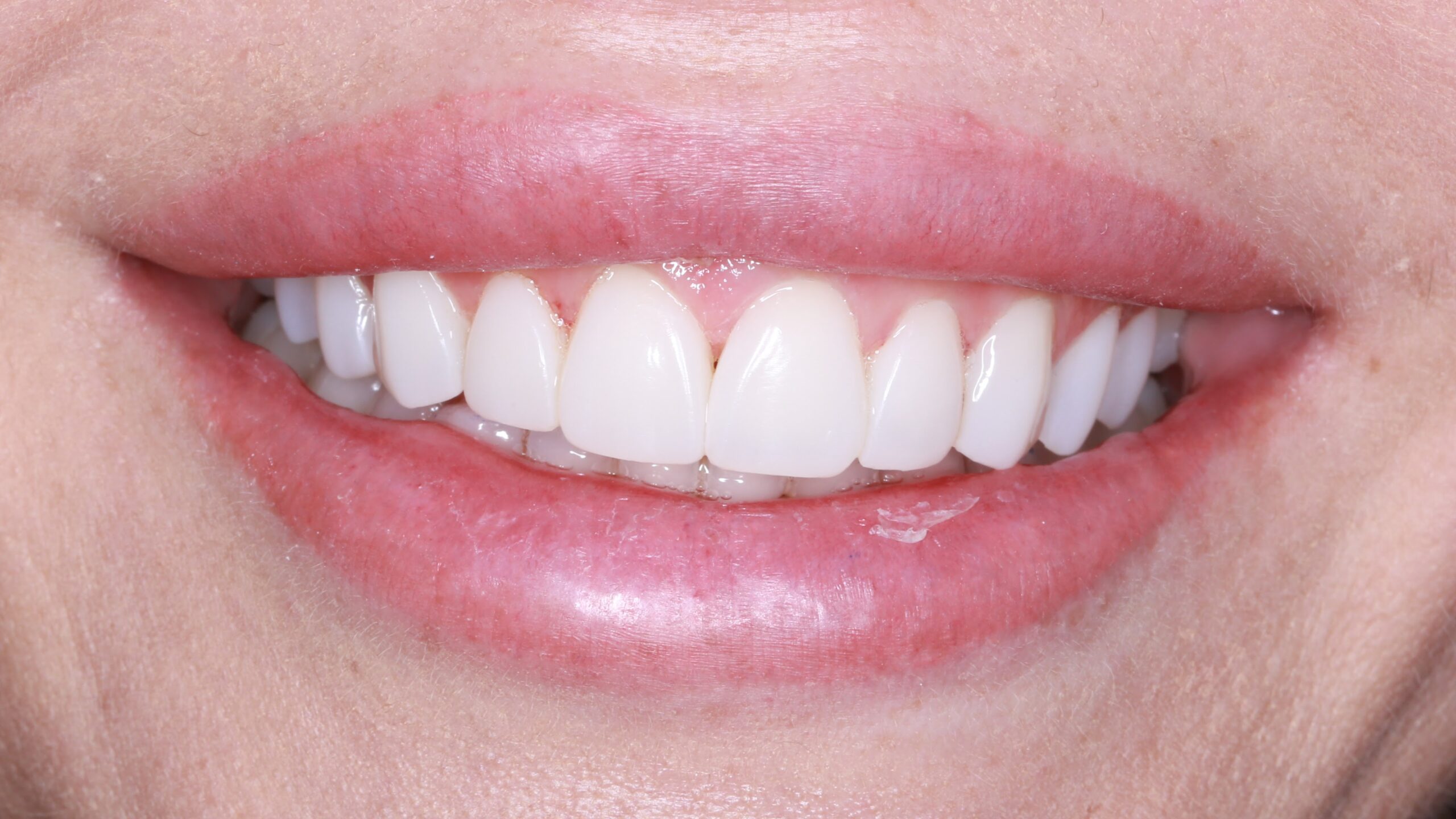 Efekt zabiegu bonding w Elite Smile Poznań - dr Judyta Babik-Kielin Metamorfoza uśmiechu bonding w Poznaniu - efekt przed i po zabiegu u lek. dent. Judyty Babik-Kielin w Elite Smile