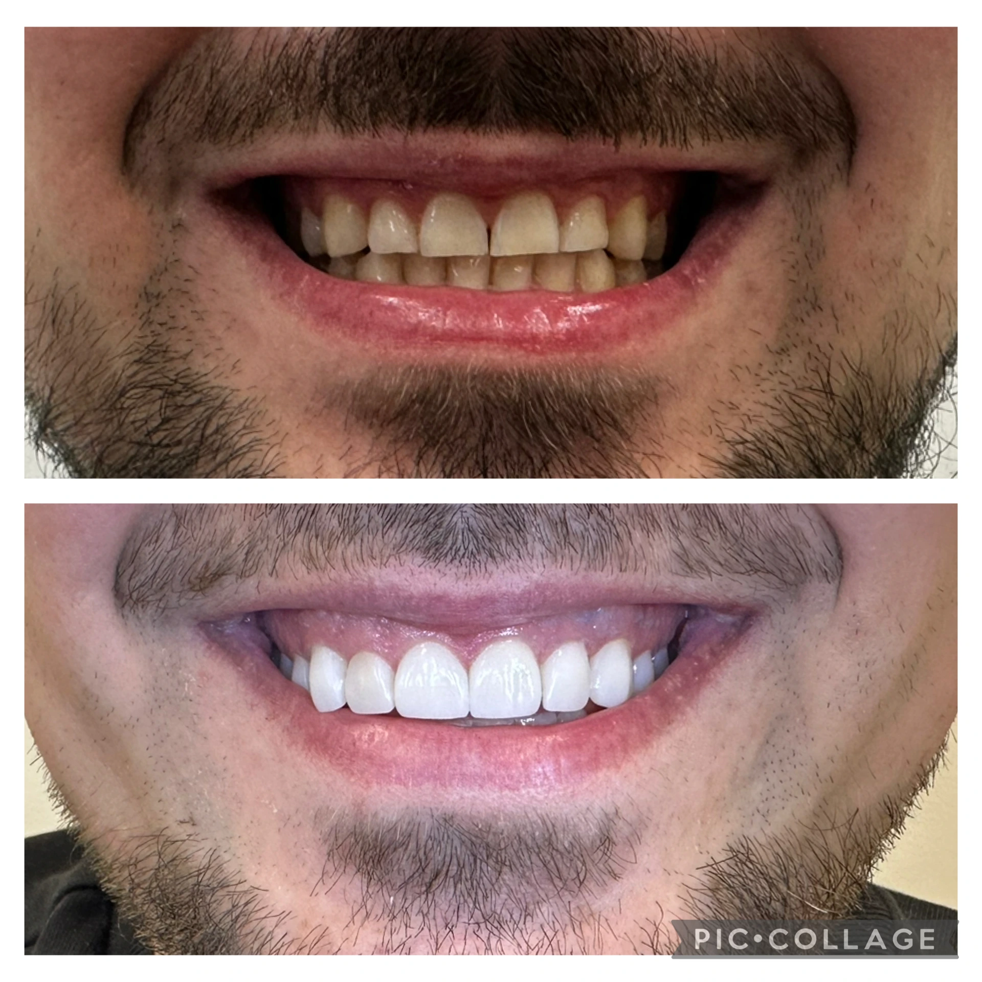 Efekt przed i po zabiegu bondingu (odbudowy kompozytowej) w klinice Elite Smile Poznań