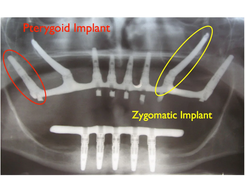 RTG panoramiczne implanty Zygoma i Quad Zygoma - zanik kości