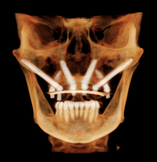 mplanty jarzmowe Zygoma i pterygoidalne model 3D - Elite Smile Poznań