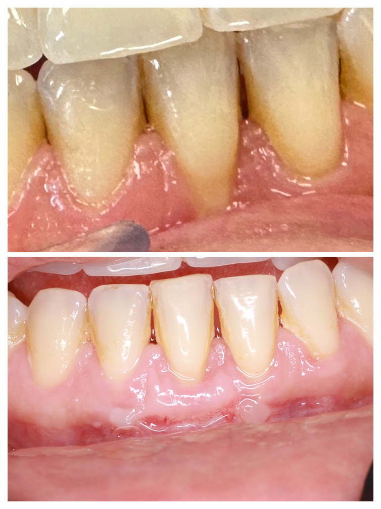 Pokrycie recesji dziąseł przed i po - mikrochirurgia periodontologiczna w Elite Smile Poznań