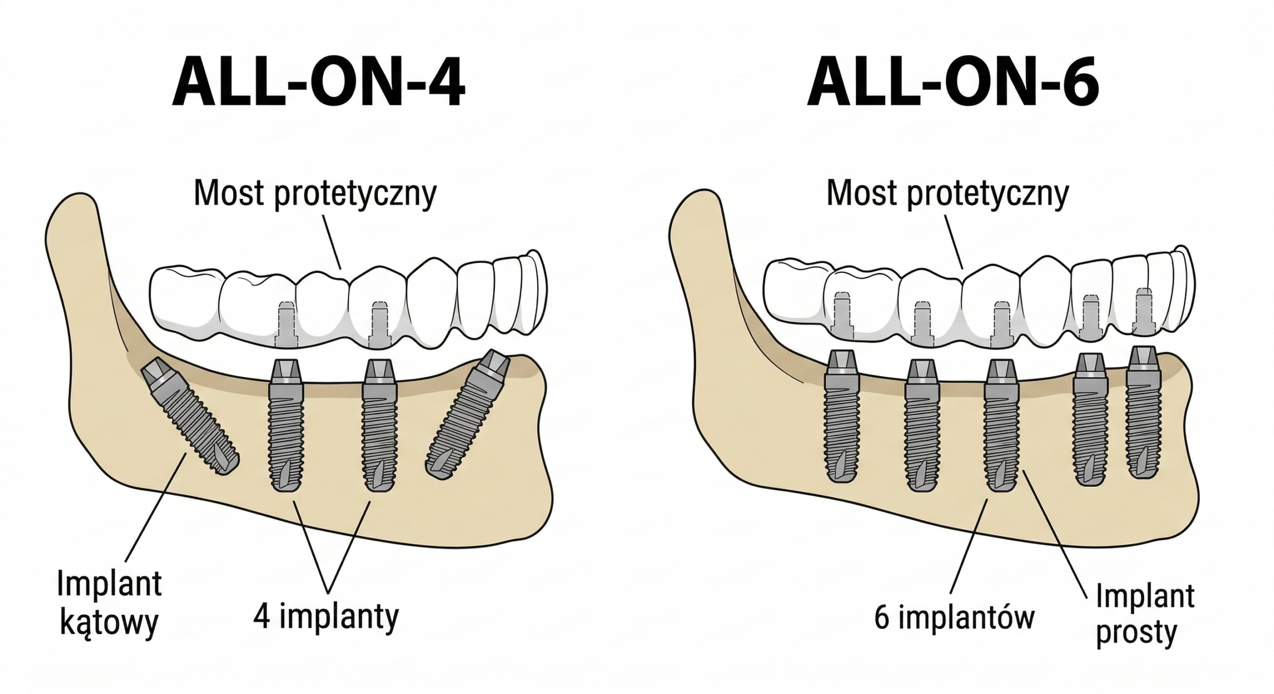 Porównanie rozmieszczenia implantów w metodzie All-on-4 i All-on-6