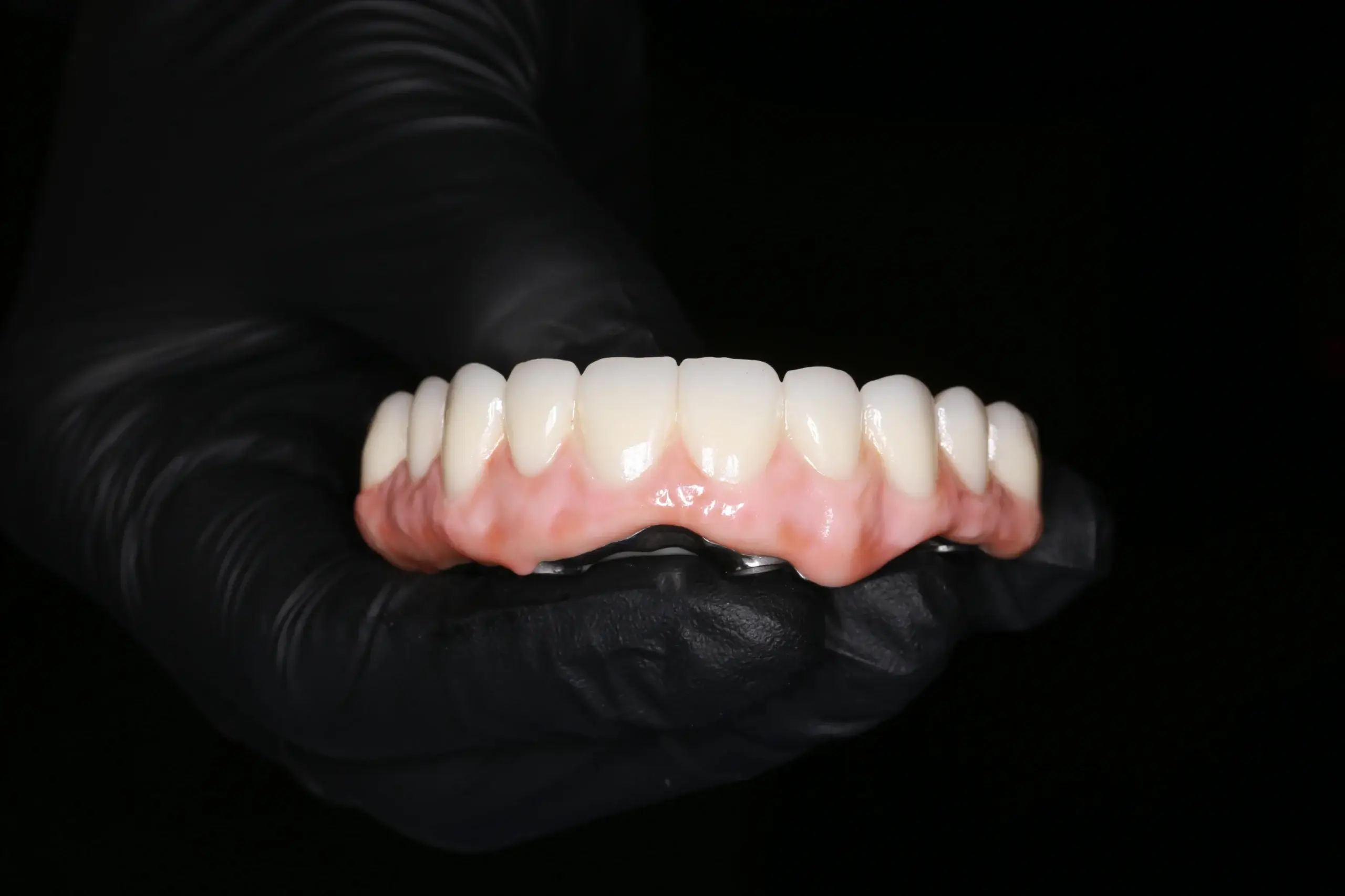 Proteza stała na implantach All-on-4 – most porcelanowy – Elite Smile Poznań