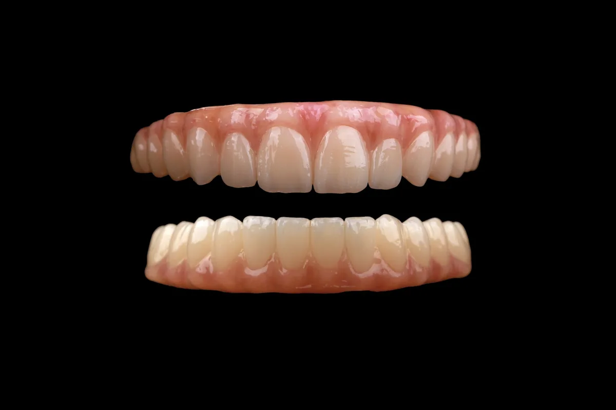 Proteza tymczasowa na implantach All-on-4 – górny i dolny łuk – Elite Smile Poznań