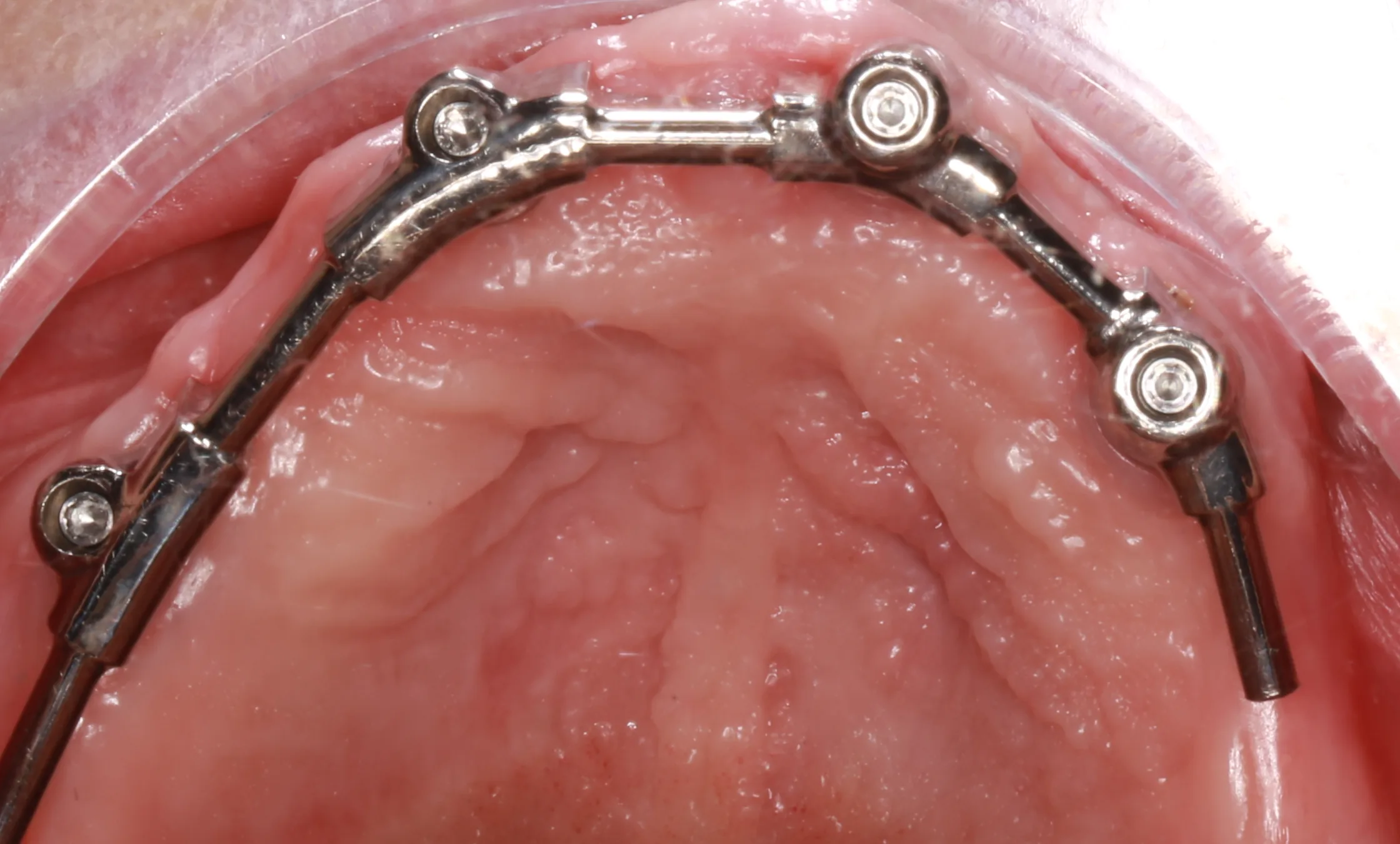 Belka na implantach w szczęce – podbudowa protezy typu overdenture