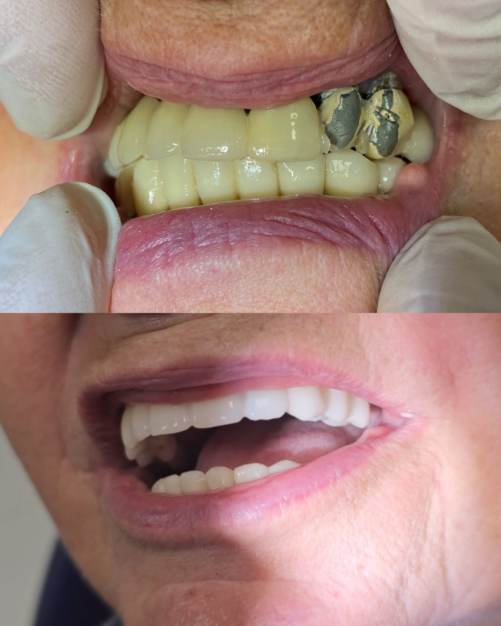 Przemiana all on 6 Poznań przed i po