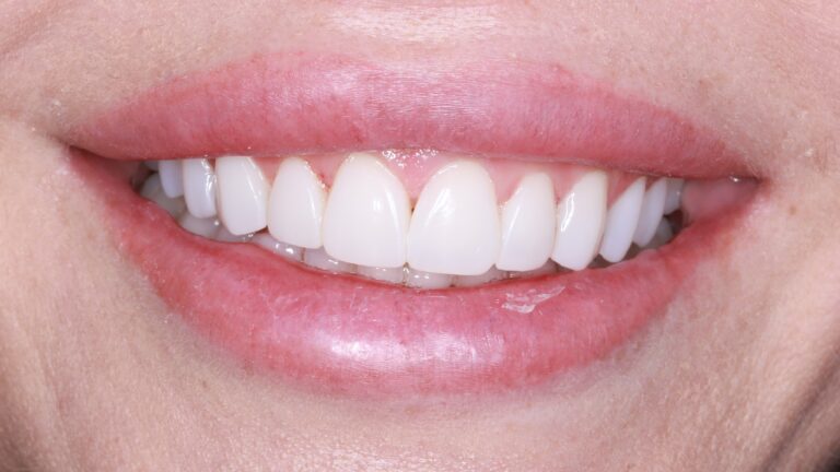 Metamorfoza uśmiechu bonding w Poznaniu - pacjentka lek. dent. Judyty Babik-Kielin, zamknięcie diastemy i korekta kształtu