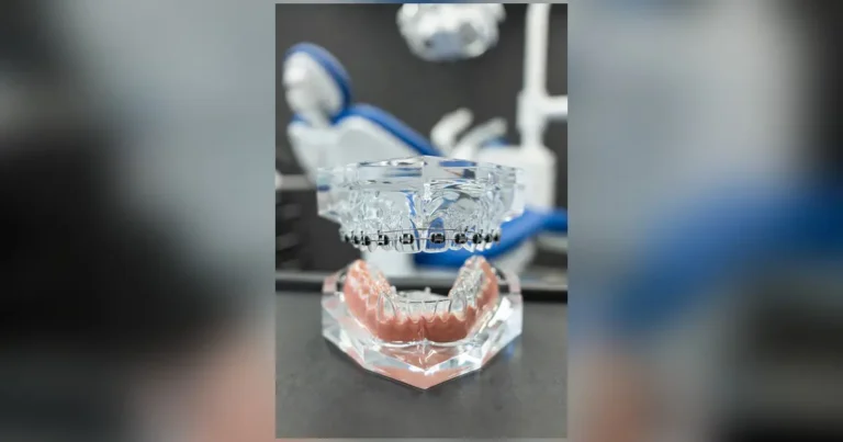 Model uzębienia z aparatem ortodontycznym założonym tylko na łuk górny — leczenie jednołukowe w klinice Elite Smile w Poznaniu