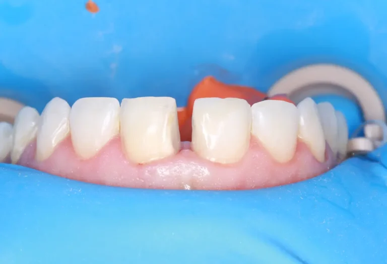 Zęby przednie górne przed założeniem licówek ceramicznych — widoczne przebarwienia, nierówności i niejednolity kształt zębów