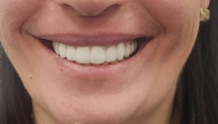 Uśmiech tej samej pacjentki po leczeniu — pełny, równy i biały uśmiech po odbudowie zębów, efekt metamorfozy uśmiechu w klinice Elite Smile w Poznaniu