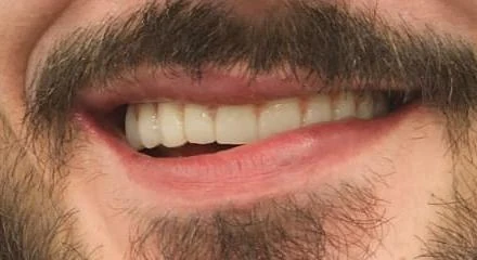 Zbliżenie ust tego samego pacjenta po leczeniu — pełny, równy i biały uśmiech po odbudowie zębów, efekt metamorfozy uśmiechu w klinice Elite Smile w Poznaniu