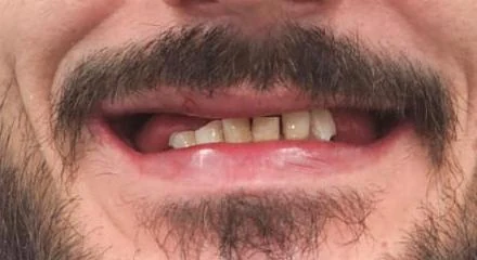 Zbliżenie ust pacjenta przed leczeniem — widoczne braki w uzębieniu i ubytki w przednim odcinku, metamorfoza uśmiechu w klinice Elite Smile w Poznaniu