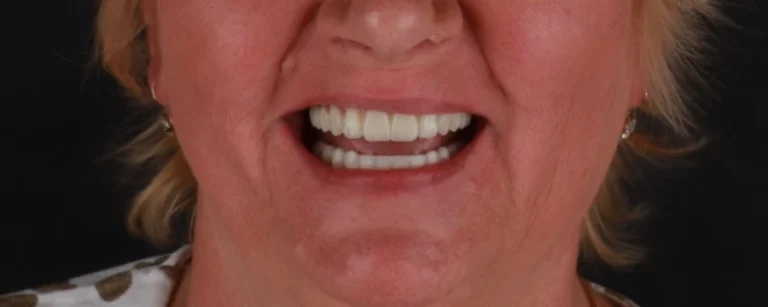 Strefa ust pacjentki po leczeniu — pełny, biały uśmiech na stałej protezie na implantach, efekt leczenia w klinice Elite Smile w Poznaniu