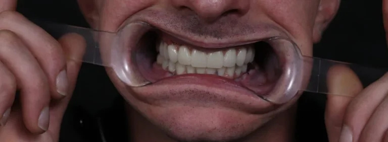 Jama ustna tego samego pacjenta po leczeniu — pełny, stały łuk zębowy na implantach w rozwieraczu, efekt leczenia w klinice Elite Smile w Poznaniu