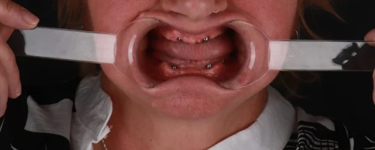 Strefa ust pacjentki przed leczeniem — rozwieracz odsłania bezzębny wyrostek z łącznikami implantów przed osadzeniem stałej protezy na implantach, klinika Elite Smile w Poznaniu