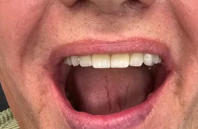 Strefa ust tego samego pacjenta po leczeniu — pełny biały łuk górny po odbudowie zębów, klinika Elite Smile w Poznaniu