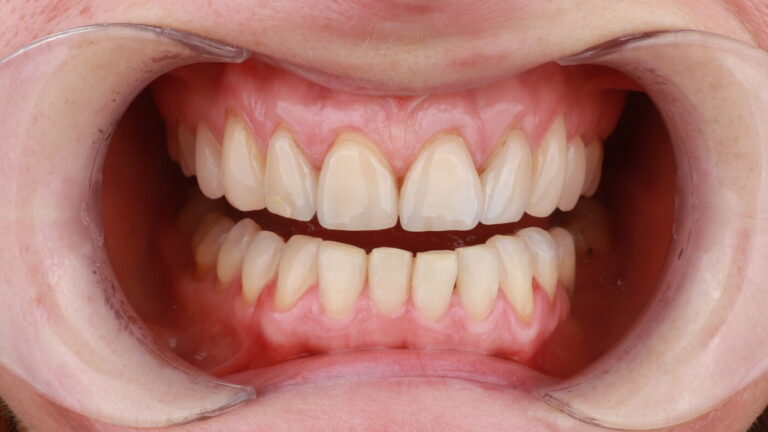 Zęby przed wykonaniem licówek 13–23 i bondingu zębów 14 oraz 24 w Elite Smile.