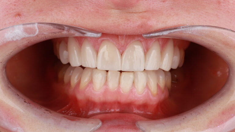 Efekt leczenia: licówki na zębach 13–23 i bonding zębów 14 oraz 24 w Elite Smile.