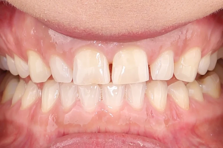Zęby przed leczeniem – przebarwienia, diastema między górnymi jedynkami i nierówne brzegi sieczne
