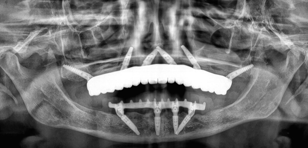 Pantomogram po rekonstrukcji All-on-X i All-on-4: 6 implantów w szczęce, w tym 2 pterygoidalne, i 4 implanty w żuchwie – Elite Smile Poznań