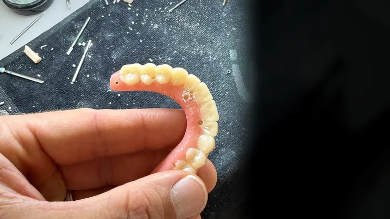 Most tymczasowy na implantach wydrukowany i scharakteryzowany w pracowni Elite Smile w Poznaniu – zęby w jeden dzień